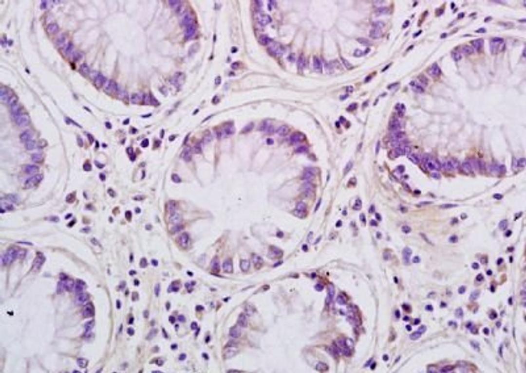 Immunohistochemical analysis of formalin-fixed paraffin embedded human colon carcinoma tissue using AQP8 antibody (dilution at 1:200)