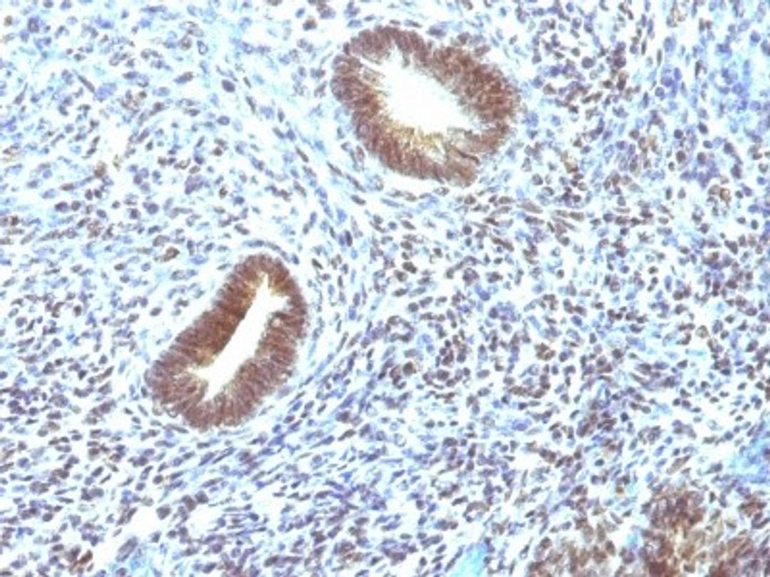 Immunohistochemistry-Paraffin: MEKK1 Antibody (2F6) [NBP2-44405] - Human Uterine Carcinoma stained with MAP3K1 Monoclonal Antibody (2F6).