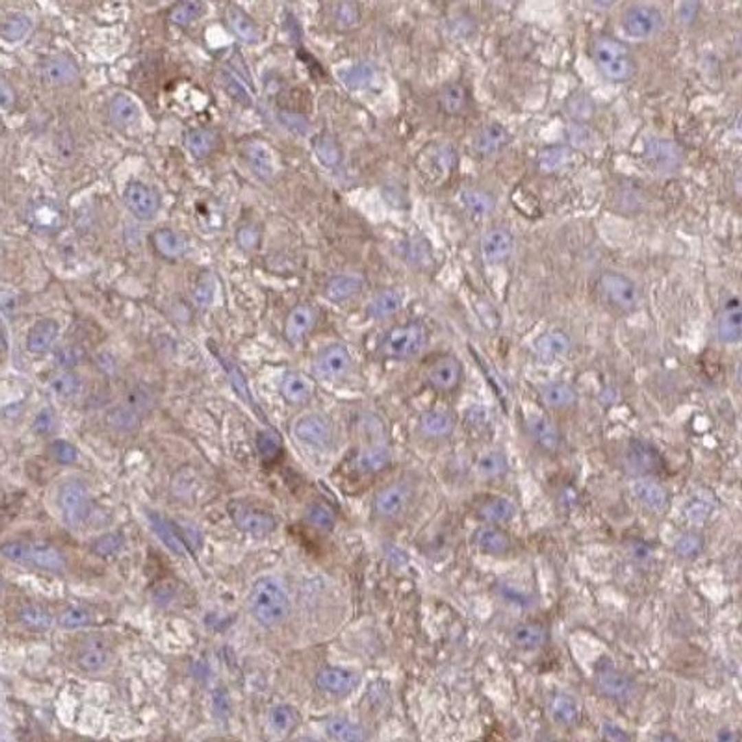 Immunohistochemistry: Desmoglein 4 Antibody [NBP2-31770] - liver cancer