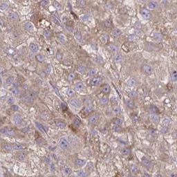 Immunohistochemistry: Desmoglein 4 Antibody [NBP2-31770] - liver cancer