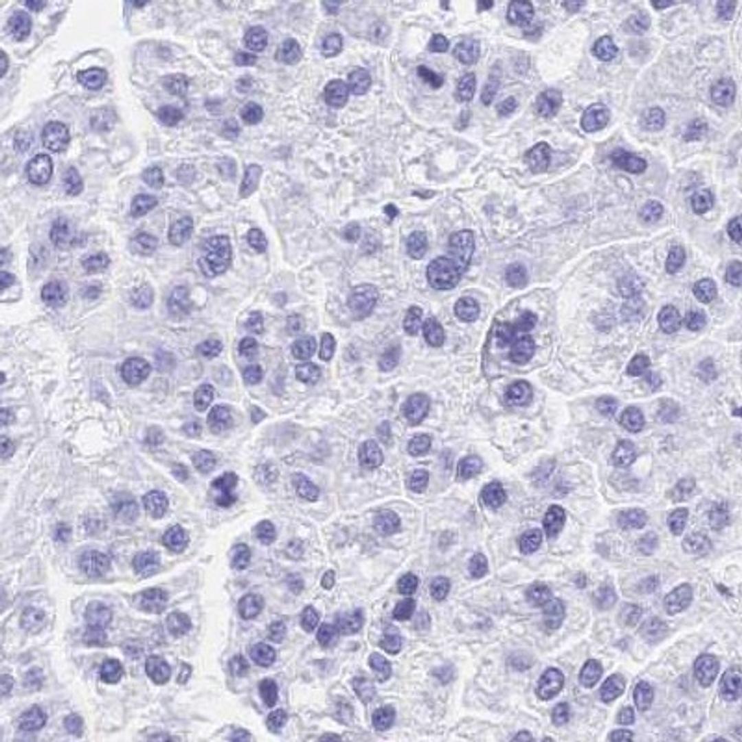 Immunohistochemistry: C20orf197 Antibody [NBP2-31846] - liver cancer