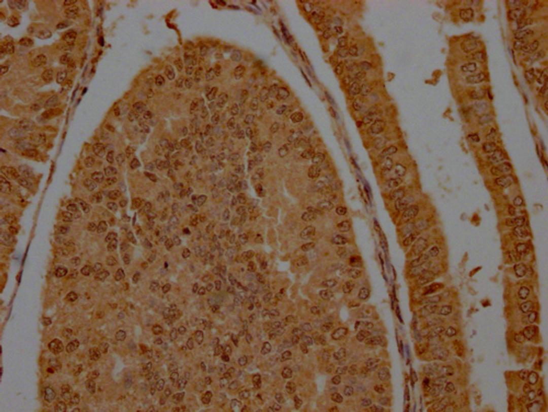 IHC image of CSB-PA009884LA01HU diluted at 1:200 and staining in paraffin-embedded human endometrial cancer performed on a Leica BondTM system. After dewaxing and hydration, antigen retrieval was mediated by high pressure in a citrate buffer (pH 6.0). Section was blocked with 10% normal goat serum 30min at RT. Then primary antibody (1% BSA) was incubated at 4°C overnight. The primary is detected by a Goat anti-rabbit polymer IgG labeled by HRP and visualized using 0.05% DAB.