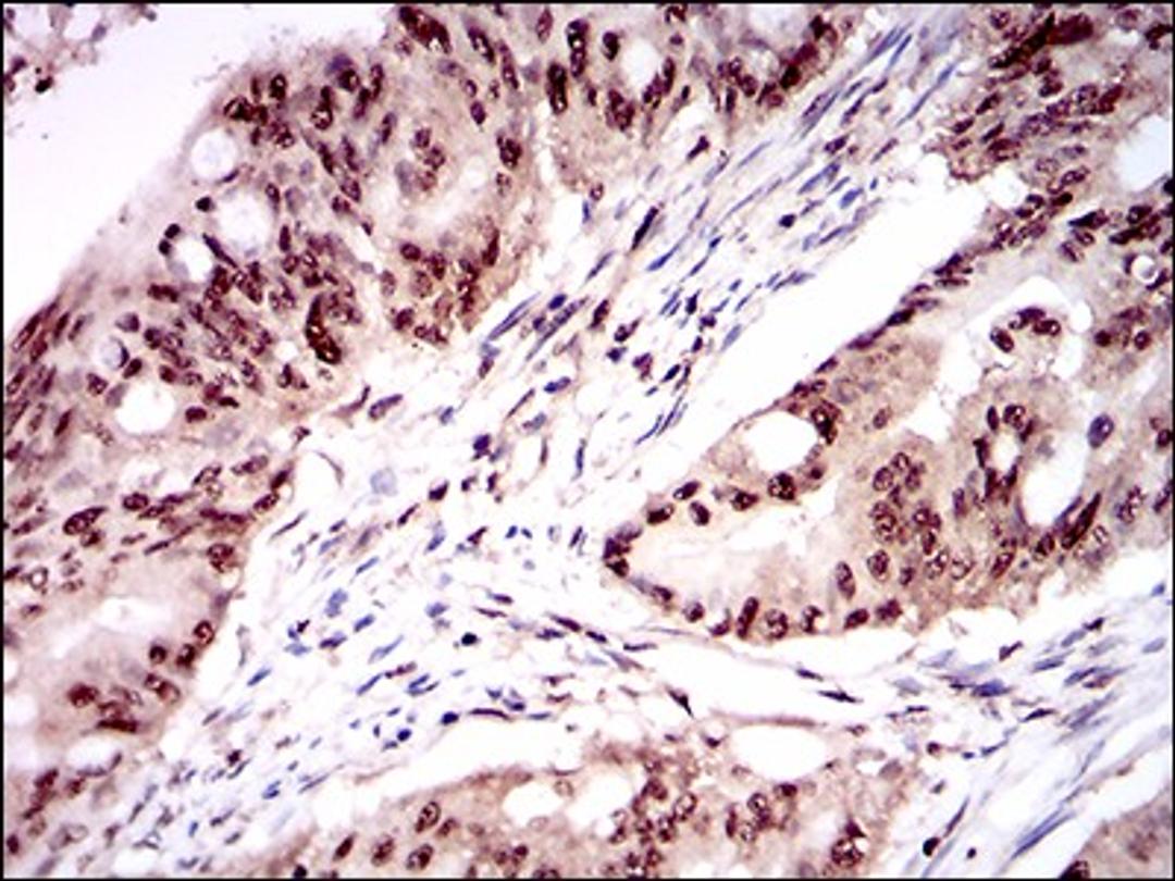 Immunohistochemistry: ONECUT3 Antibody (10B2F5) [NBP2-37340] - Immunohistochemical analysis of paraffin-embedded rectum cancer tissues using ONECUT3 mouse mAb with DAB staining.