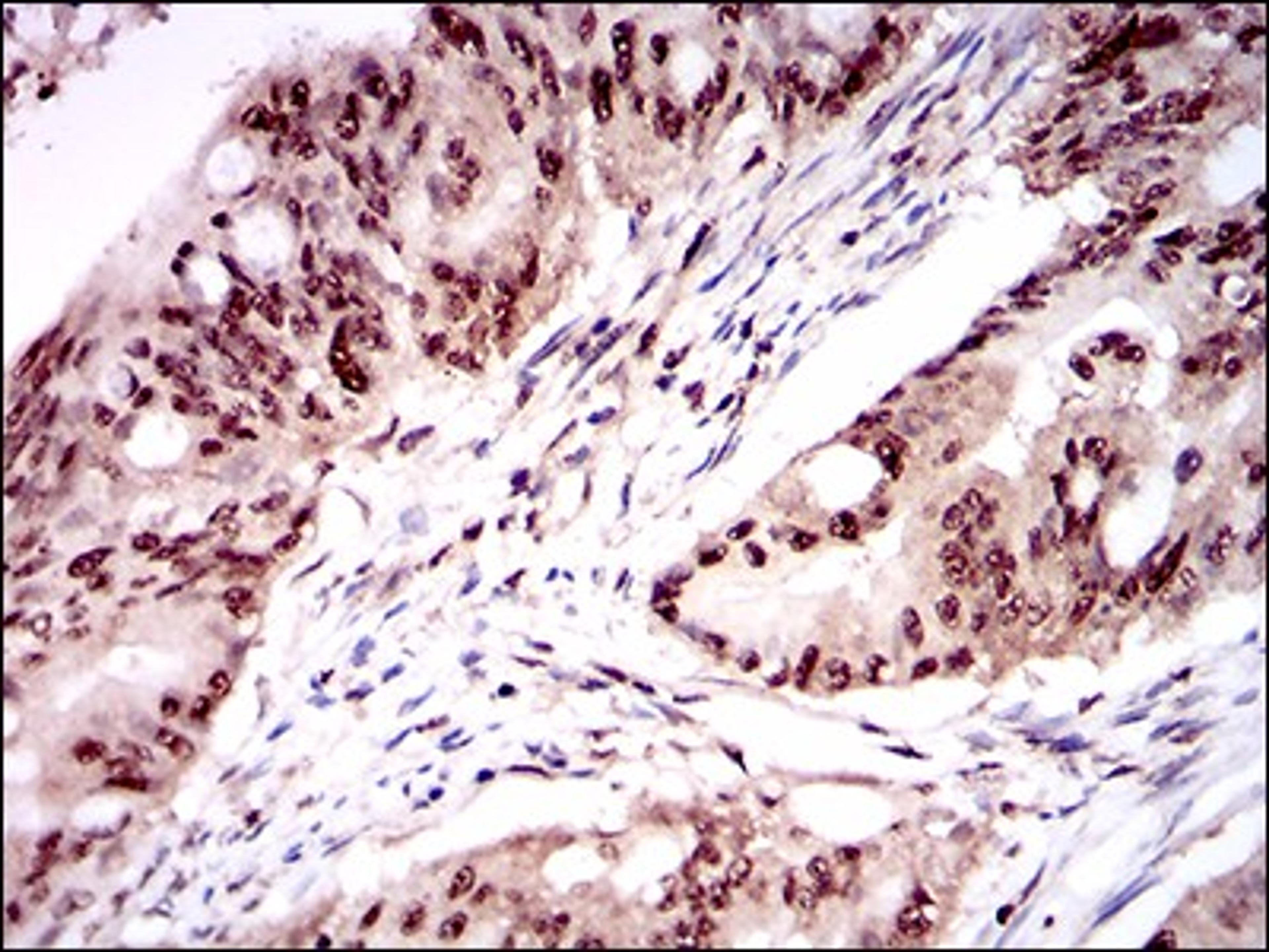 Immunohistochemistry: ONECUT3 Antibody (10B2F5) [NBP2-37340] - Immunohistochemical analysis of paraffin-embedded rectum cancer tissues using ONECUT3 mouse mAb with DAB staining.