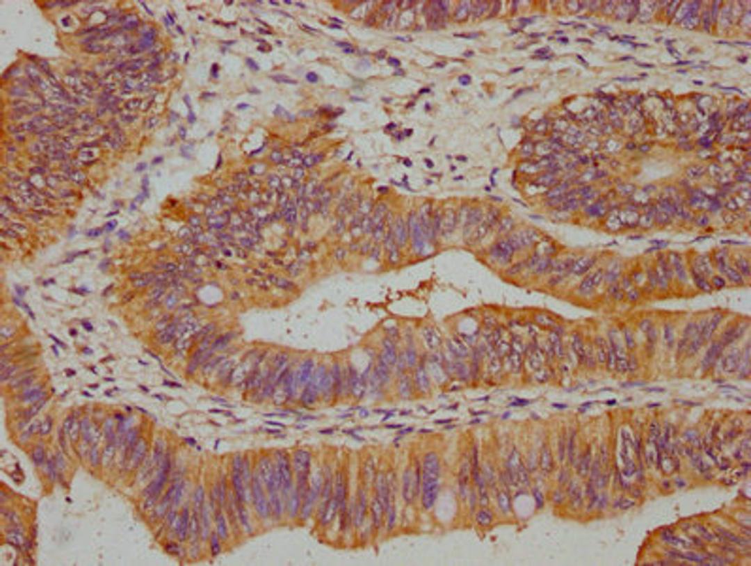 IHC image of CSB-PA862001LA01HU diluted at 1:500 and staining in paraffin-embedded human colon cancer performed on a Leica BondTM system. After dewaxing and hydration, antigen retrieval was mediated by high pressure in a citrate buffer (pH 6.0). Section was blocked with 10% normal goat serum 30min at RT. Then primary antibody (1% BSA) was incubated at 4°C overnight. The primary is detected by a biotinylated secondary antibody and visualized using an HRP conjugated SP system.