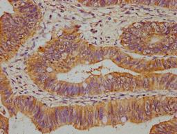 IHC image of CSB-PA862001LA01HU diluted at 1:500 and staining in paraffin-embedded human colon cancer performed on a Leica BondTM system. After dewaxing and hydration, antigen retrieval was mediated by high pressure in a citrate buffer (pH 6.0). Section was blocked with 10% normal goat serum 30min at RT. Then primary antibody (1% BSA) was incubated at 4°C overnight. The primary is detected by a biotinylated secondary antibody and visualized using an HRP conjugated SP system.