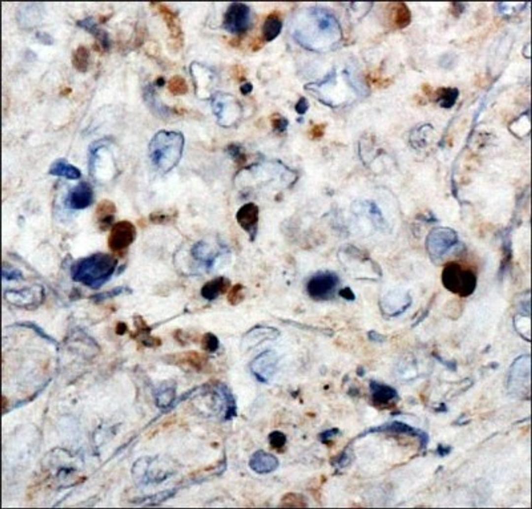 Immunohistochemistry: WT1 Antibody (6F-H2) [NB110-60011] - IHC analysis of Wilms Tumor 1 in human renal cancer using DAB with hematoxylin counterstain.