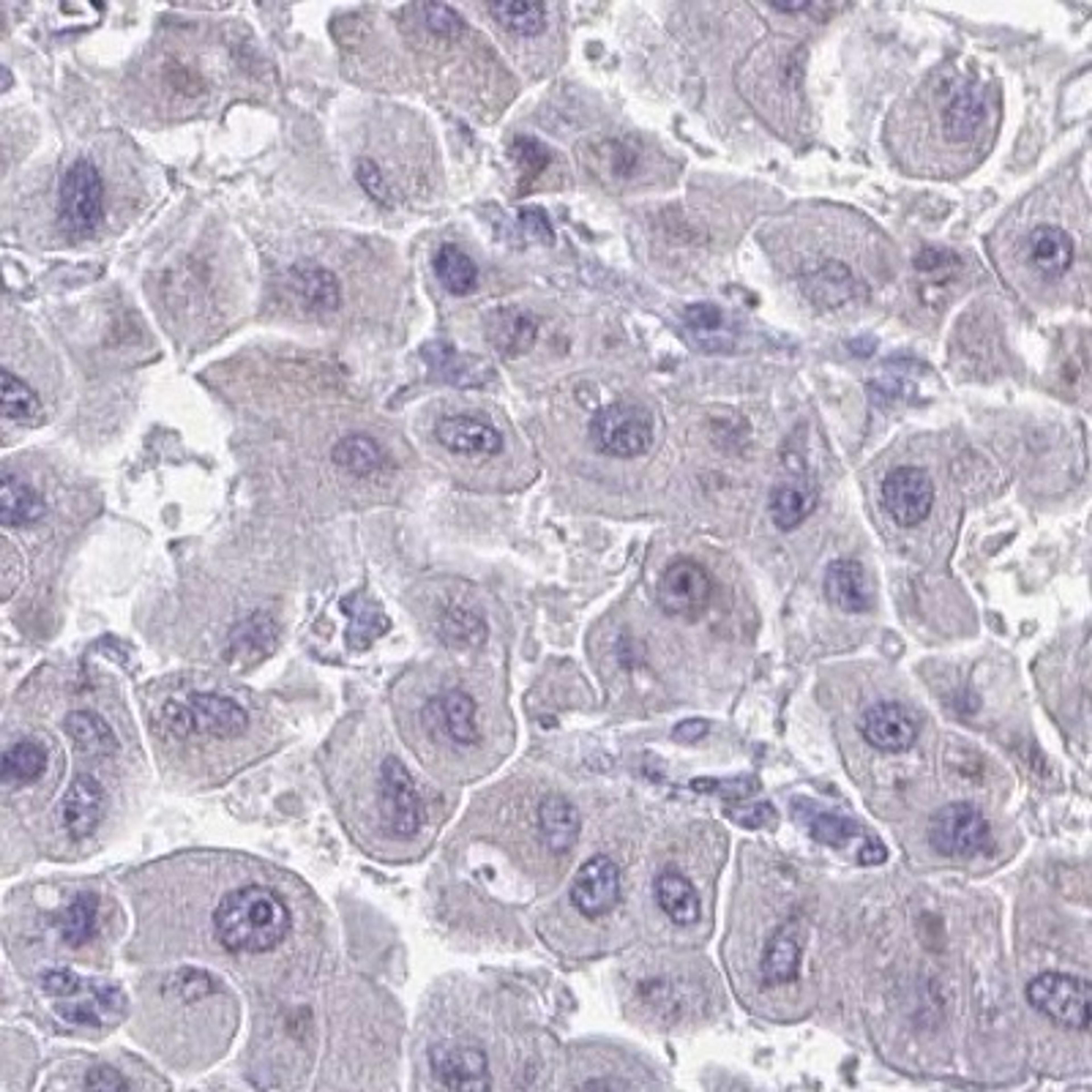 Immunohistochemistry: TMEM41A Antibody [NBP2-31743] - liver cancer