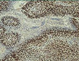 Immunohistochemistry: HIF-1 beta Antibody (H1beta234) [NB100-124] - Immunohistochemical staining of human glioblastoma multi-forme utilizing anti-HIF-1 Beta.