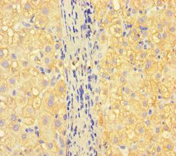 Immunohistochemistry of paraffin-embedded human liver cancer using CSB-PA388827LA01HU at dilution of 1:100