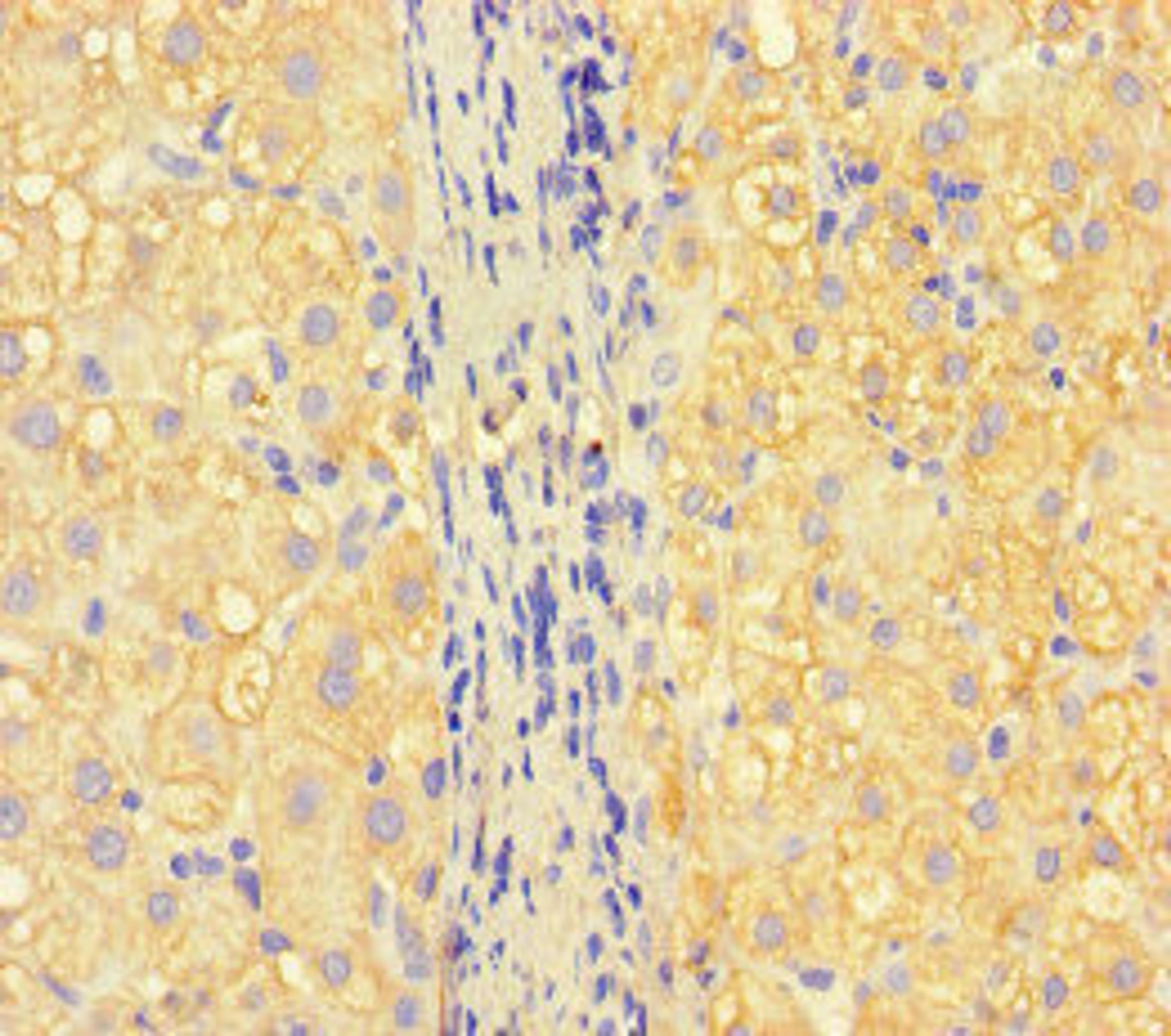 Immunohistochemistry of paraffin-embedded human liver cancer using CSB-PA388827LA01HU at dilution of 1:100