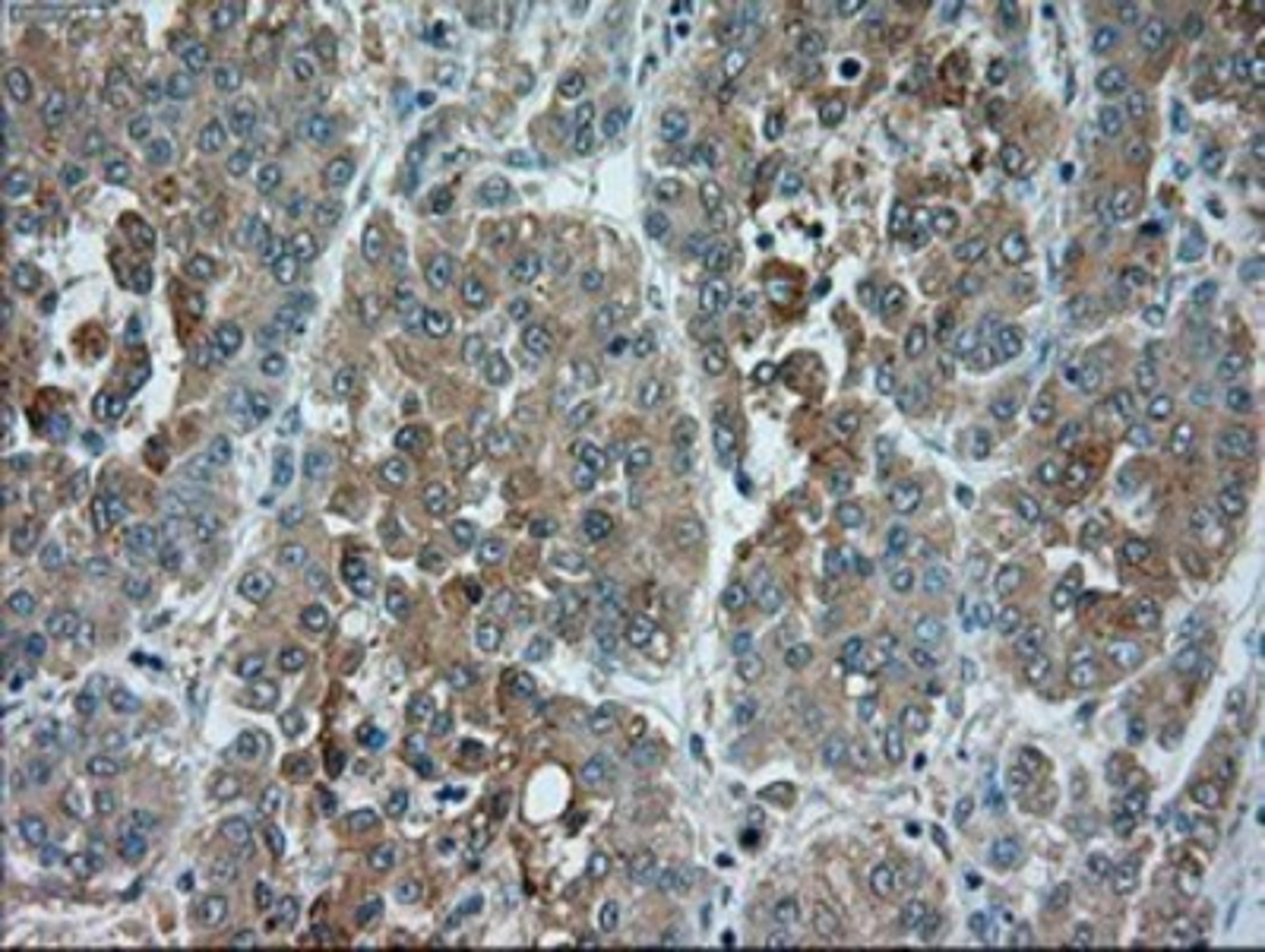 Immunohistochemistry-Paraffin: TRPM4 Antibody (10H5) [NBP1-48036] - Staining of paraffin-embedded Carcinoma of Human liver tissue using anti-TRPM4 mouse monoclonal antibody.