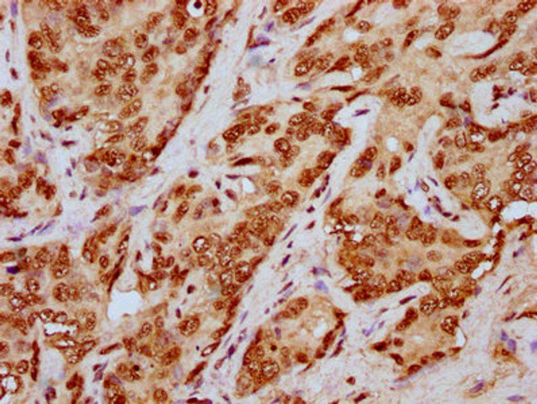 IHC image of CSB-PA010429OA79npropHU diluted at 1:20 and staining in paraffin-embedded human liver cancer performed on a Leica BondTM system. After dewaxing and hydration, antigen retrieval was mediated by high pressure in a citrate buffer (pH 6.0). Section was blocked with 10% normal goat serum 30min at RT. Then primary antibody (1% BSA) was incubated at 4&deg;C overnight. The primary is detected by a biotinylated secondary antibody and visualized using an HRP conjugated SP system.