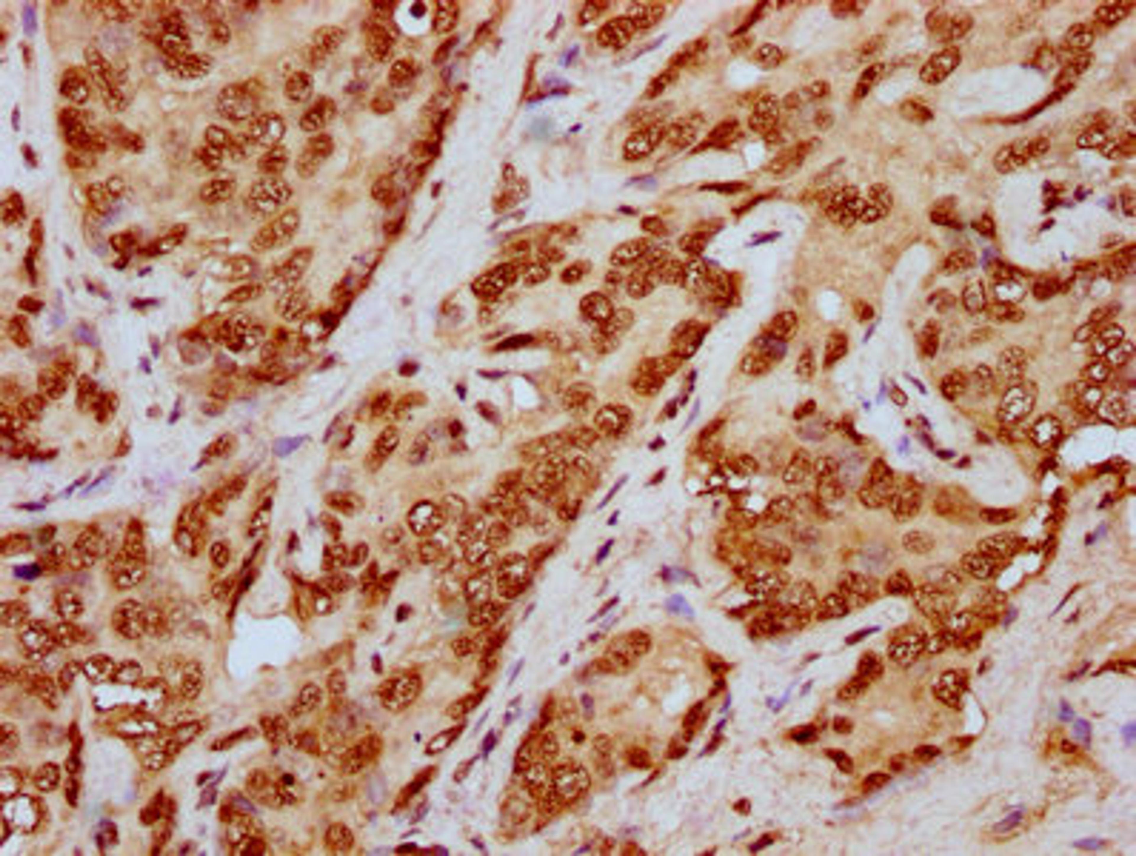 IHC image of CSB-PA010429OA79npropHU diluted at 1:20 and staining in paraffin-embedded human liver cancer performed on a Leica BondTM system. After dewaxing and hydration, antigen retrieval was mediated by high pressure in a citrate buffer (pH 6.0). Section was blocked with 10% normal goat serum 30min at RT. Then primary antibody (1% BSA) was incubated at 4&deg;C overnight. The primary is detected by a biotinylated secondary antibody and visualized using an HRP conjugated SP system.