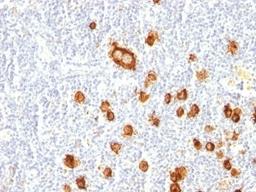 Formalin-fixed, paraffin-embedded human Hodgkin's lymphoma stained with CD15 antibody (FUT4/815).