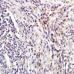 Immunohistochemical analysis of formalin-fixed and paraffin embedded human colon carcinoma tissue (dilution at:1:200) using NGAL antibody