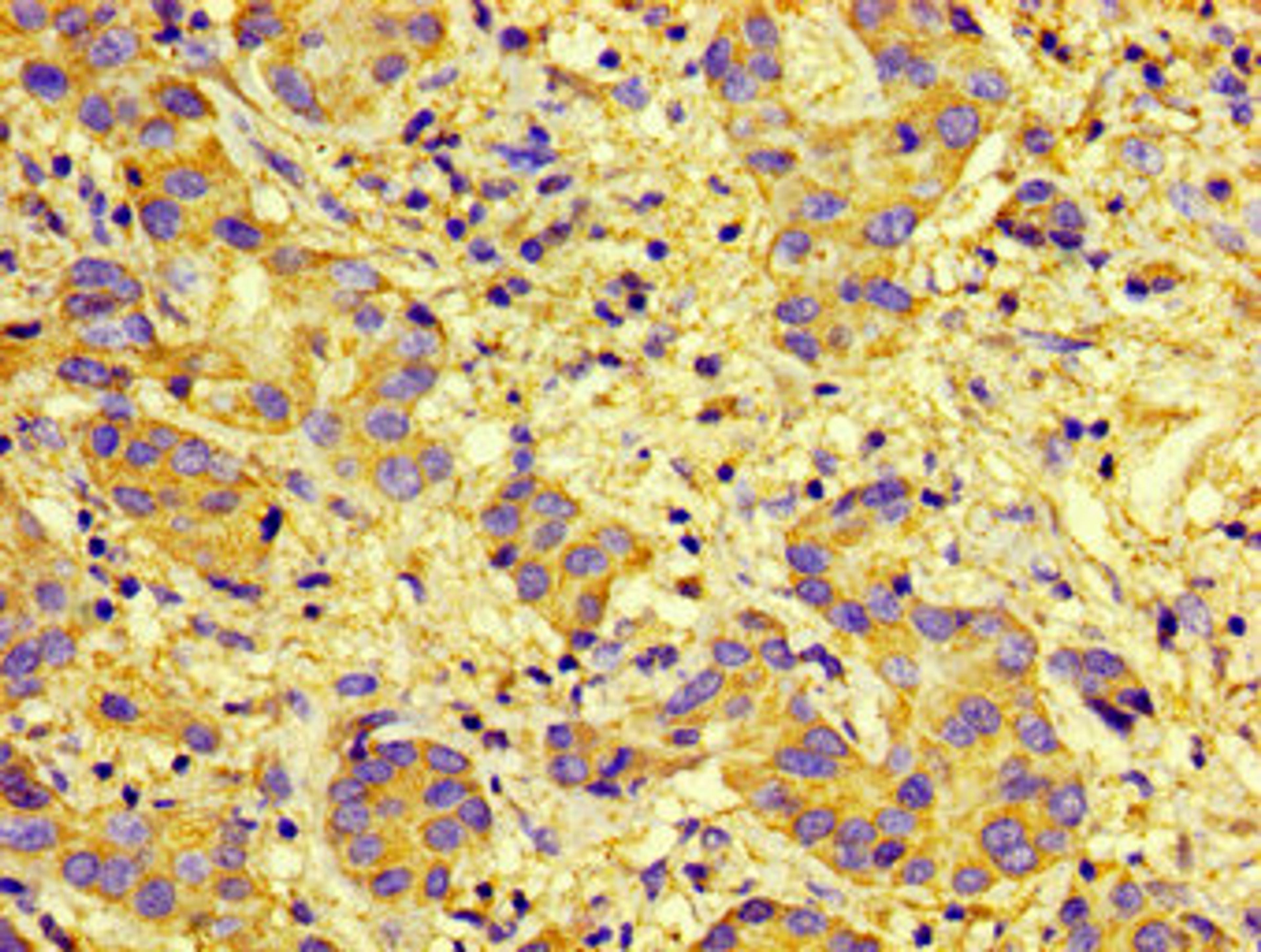Immunohistochemistry of paraffin-embedded human liver cancer using CSB-PA006255LA01HU at dilution of 1:100