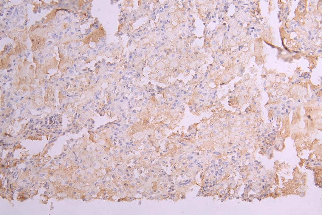 IHC image of CSB-RA012352MA1HU diluted at 1：100 and staining in paraffin-embedded human lung tissue performed on a Leica BondTM system. After dewaxing and hydration, antigen retrieval was mediated by high pressure in a citrate buffer (pH 6.0). Section was blocked with 10% normal goat serum 30min at RT. Then primary antibody (1% BSA) was incubated at 4°C overnight. The primary is detected by a Goat anti-human polymer IgG labeled by HRP and visualized using 0.05% DAB.