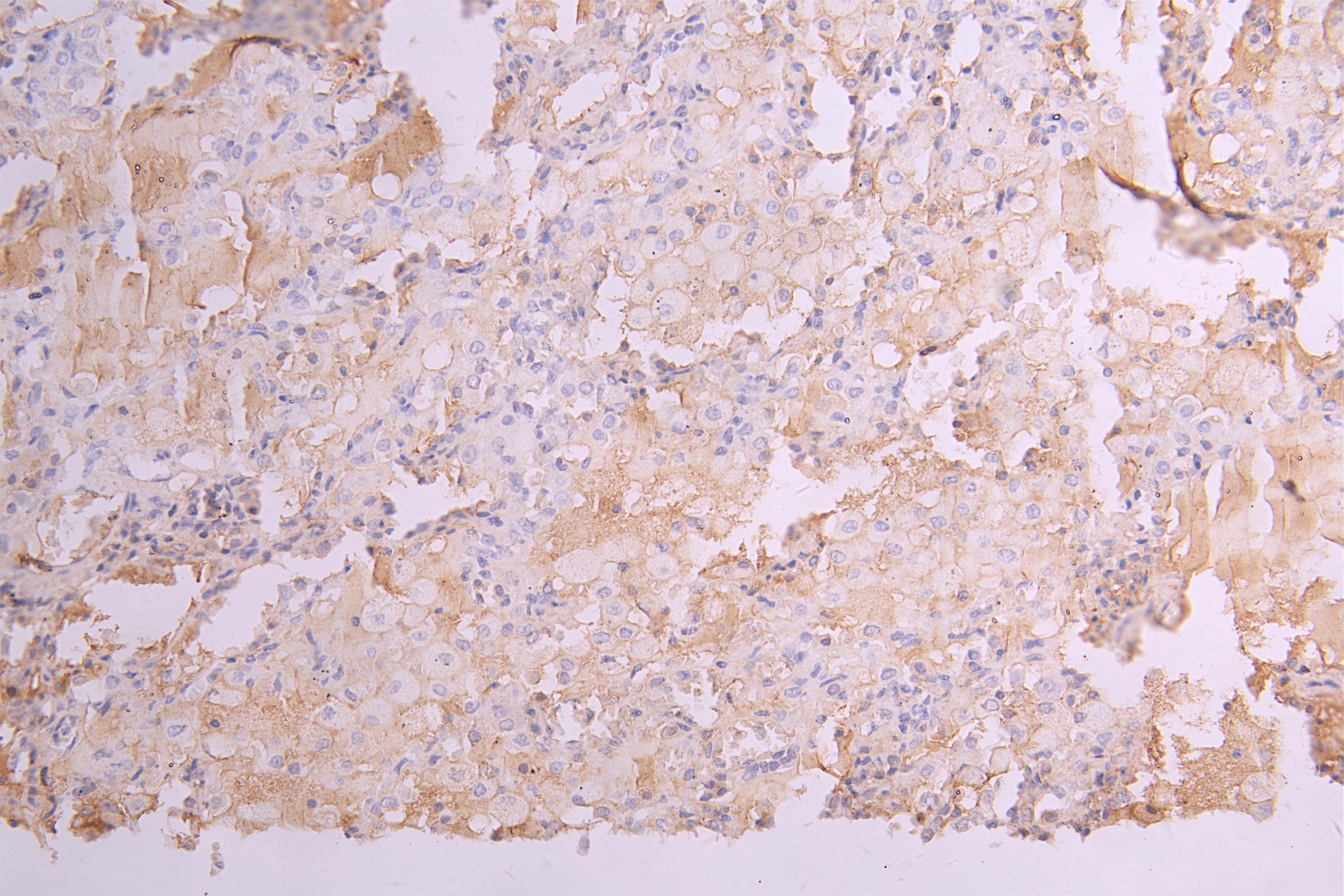 IHC image of CSB-RA012352MA1HU diluted at 1：100 and staining in paraffin-embedded human lung tissue performed on a Leica BondTM system. After dewaxing and hydration, antigen retrieval was mediated by high pressure in a citrate buffer (pH 6.0). Section was blocked with 10% normal goat serum 30min at RT. Then primary antibody (1% BSA) was incubated at 4°C overnight. The primary is detected by a Goat anti-human polymer IgG labeled by HRP and visualized using 0.05% DAB.