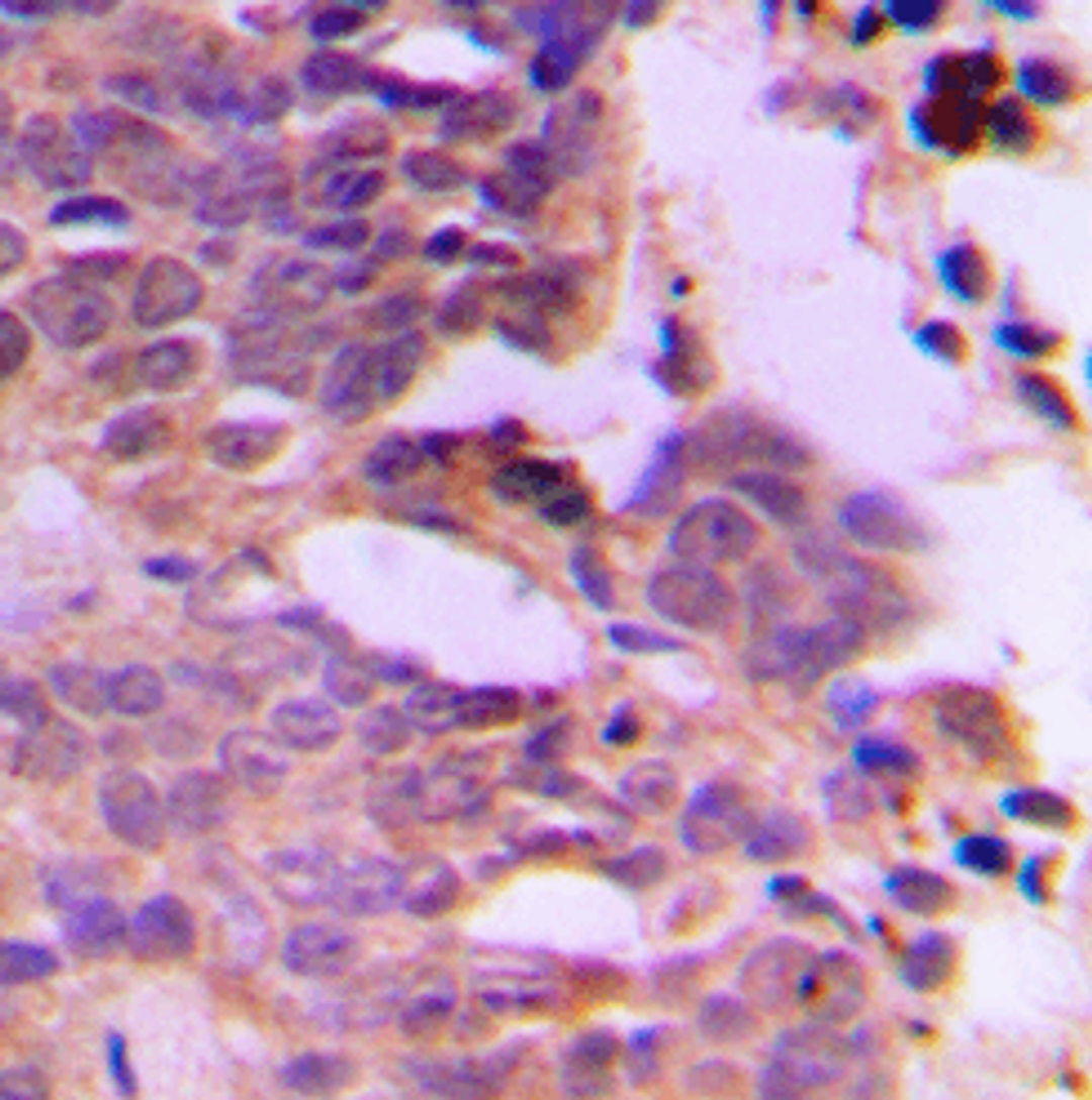 Immunohistochemical staining of human breast cancer using SIAH1/2 antibody