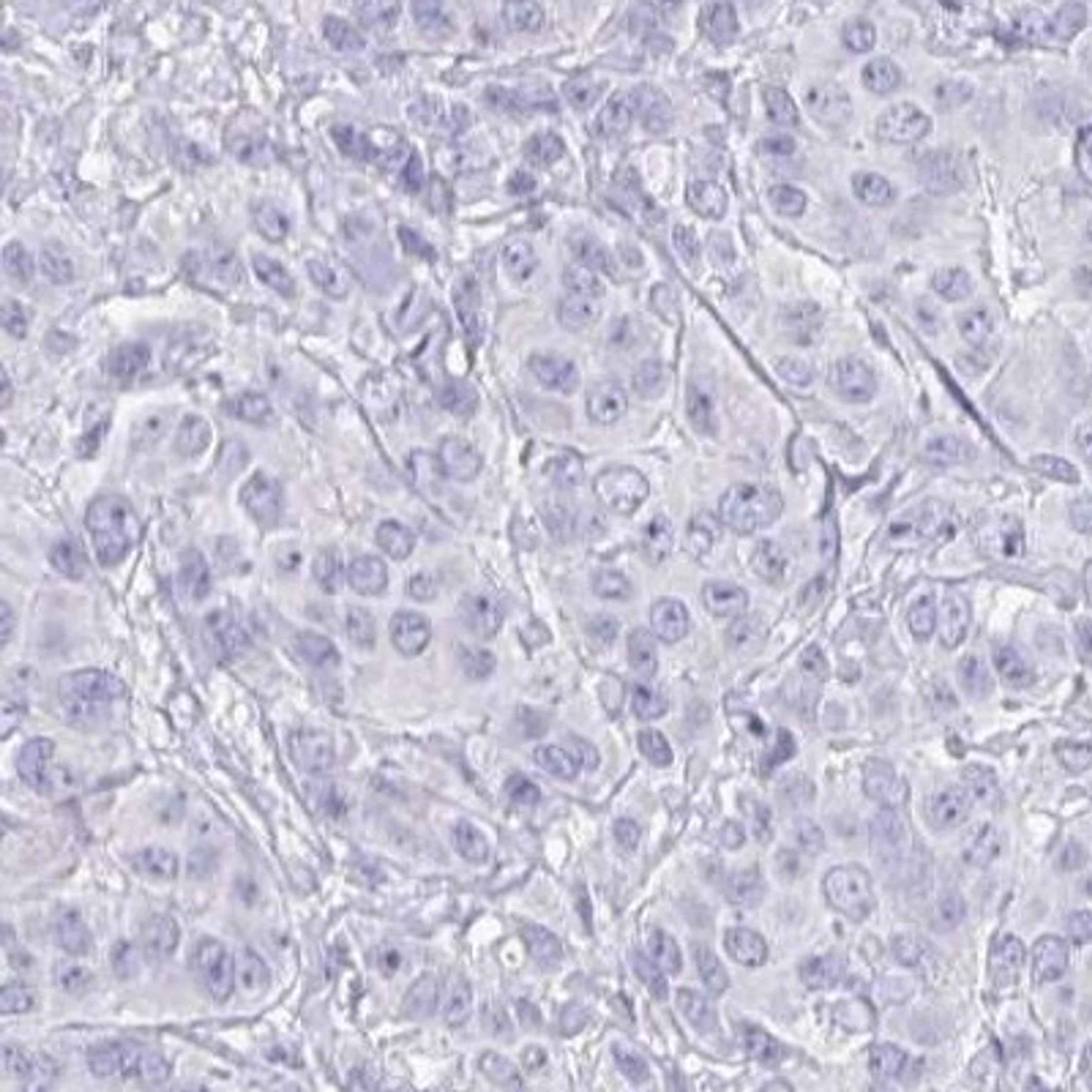 Immunohistochemistry: PLA2G1B Antibody [NBP2-32569] - breast cancer