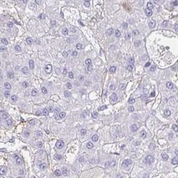 Immunohistochemistry: LHFP Antibody [NBP2-31735] - liver cancer