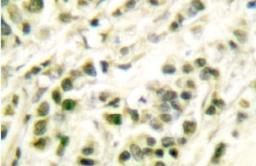 Immunohistochemistry-Paraffin: DNA Polymerase beta Antibody [NB100-91734] - Paraffin embedded human breast carcinoma tissue.