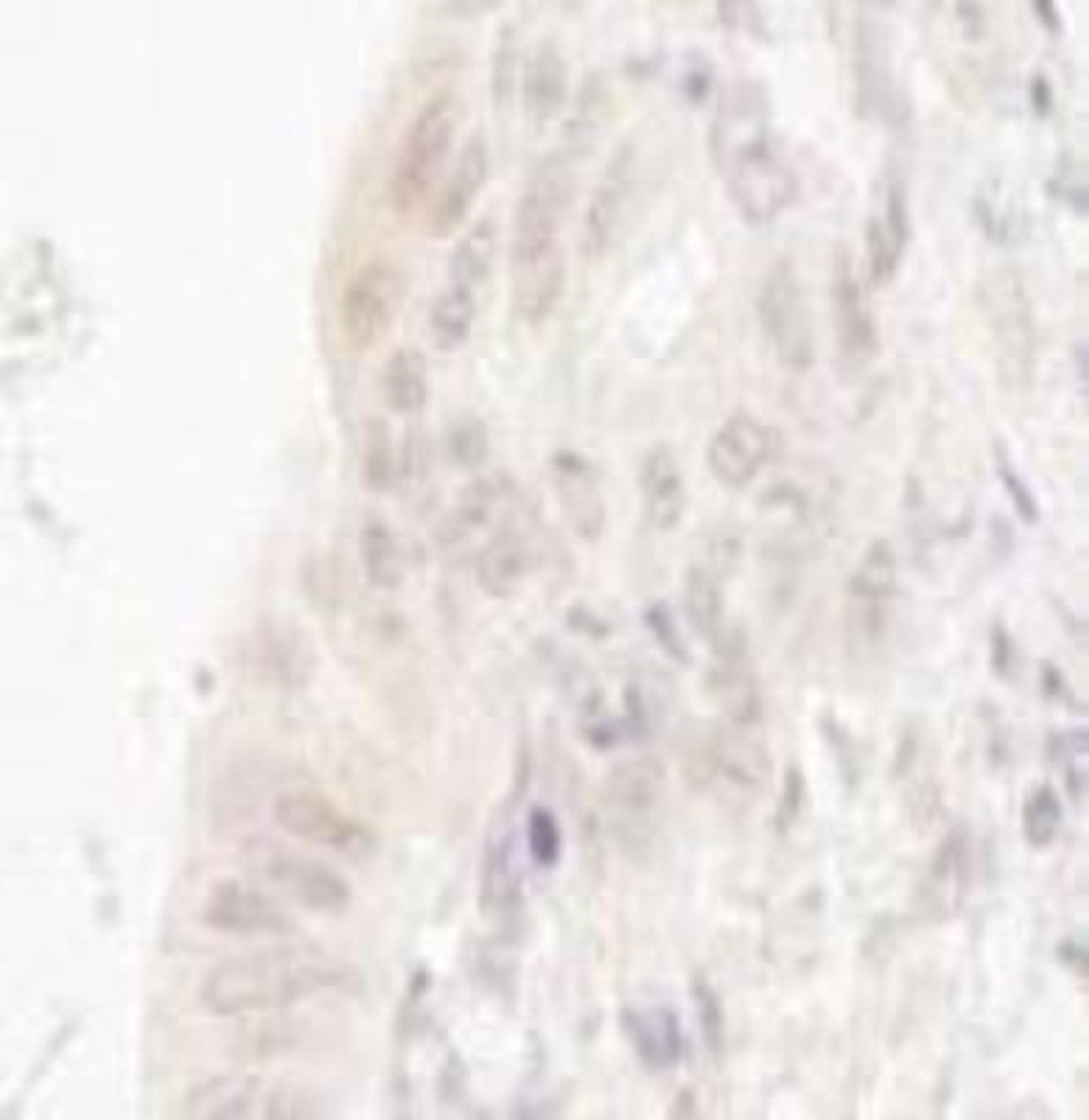 Immunohistochemistry-Paraffin: CASC5 Antibody [NB100-2586] - FFPE section of human lung carcinoma.  Affinity purified rabbit anti-CASC5 used at a dilution of 1:250.