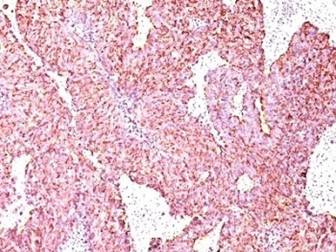 Formalin-fixed, paraffin-embedded human small cell lung carcinoma stained with Chromogranin A antibody (SPM585)