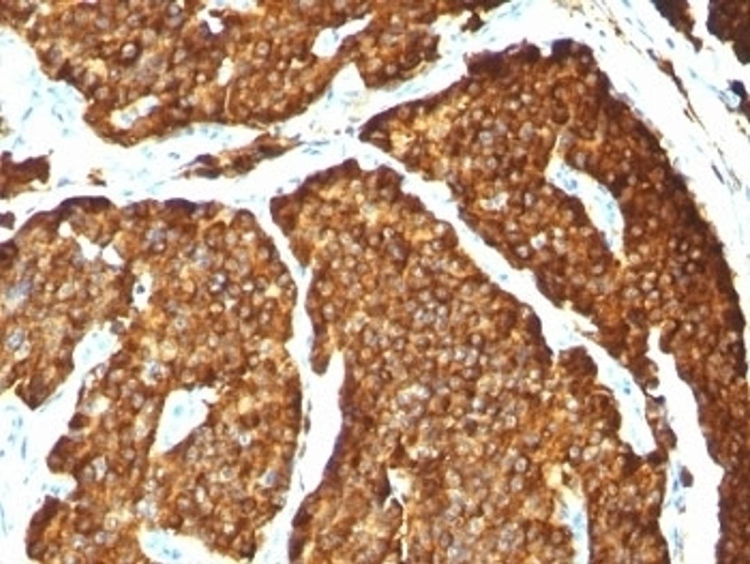 Formalin-paraffin human pheochromocytoma stained with Chromogranin A antibody (CHGA/777)