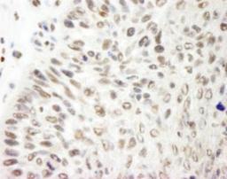 Immunohistochemistry-Paraffin: APRIN Antibody [NB100-755] - Section of human laryngeal squamous cell  carcinoma.