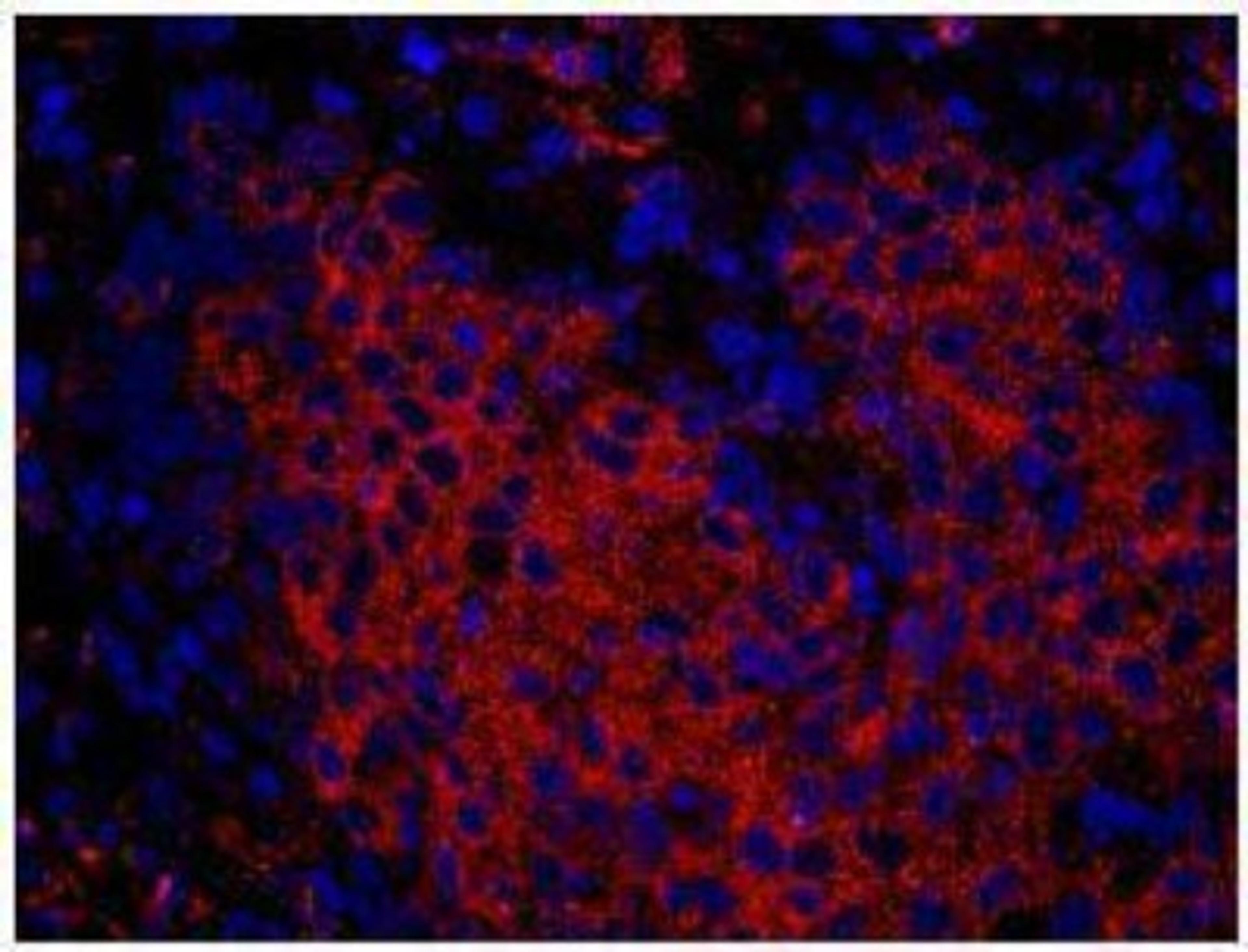 Immunocytochemistry/Immunofluorescence: CHIP Antibody [NB100-77316] - Human breast carcinoma rabbit anti-STUB1/CHIP used at a dilution of 1:100. Detection: Red-fluorescent goat anti-rabbit IgG highly  cross-adsorbed Antibody used at a dilution of 1:100.