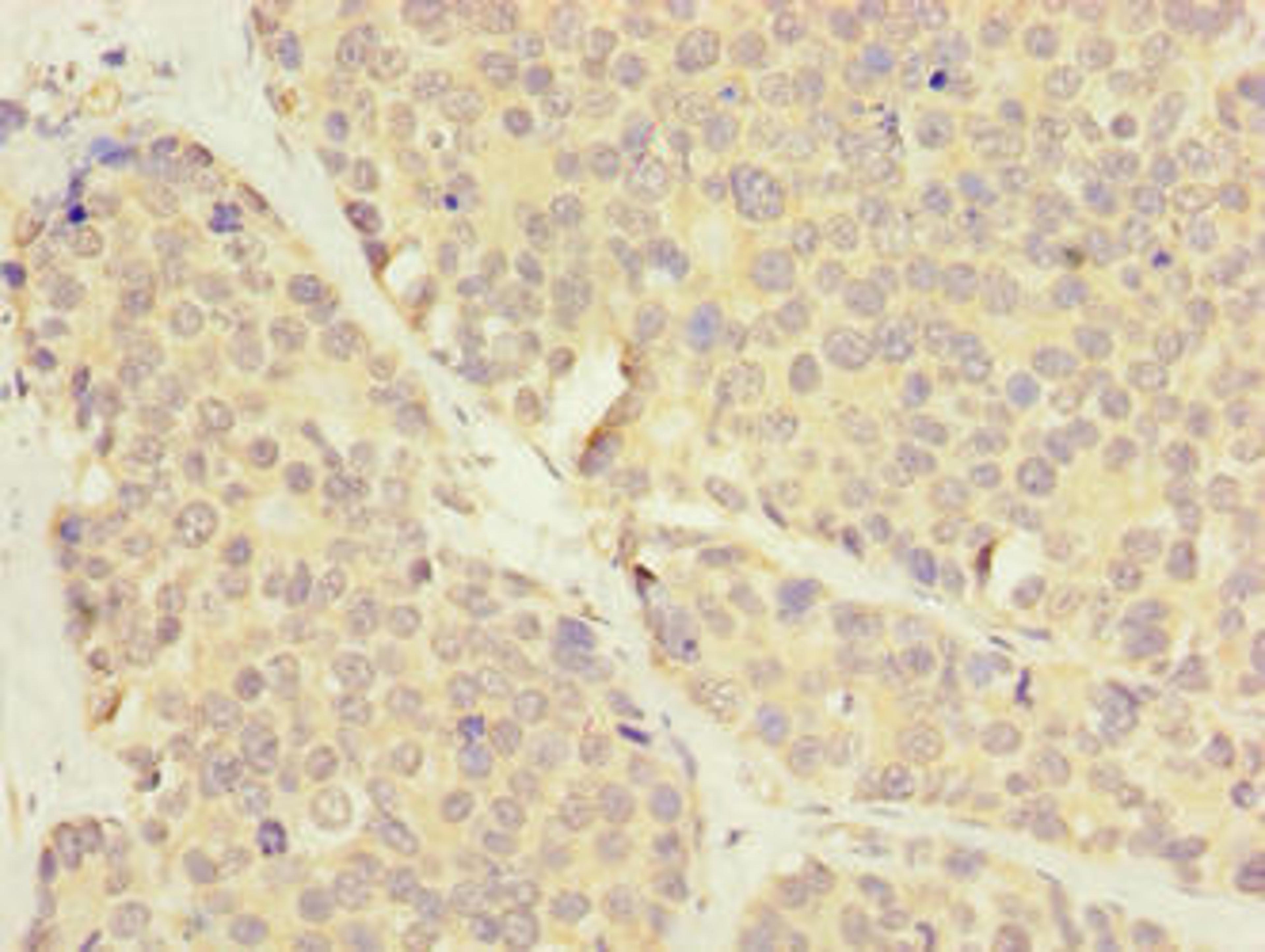 Immunohistochemistry of paraffin-embedded human gastric cancer using CSB-PA743982LA01HU at dilution of 1:100