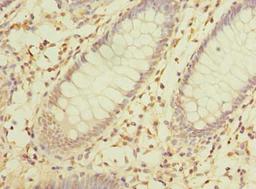 Immunohistochemistry of paraffin-embedded human colon cancer using CSB-PA882128LA01HU at dilution of 1:100