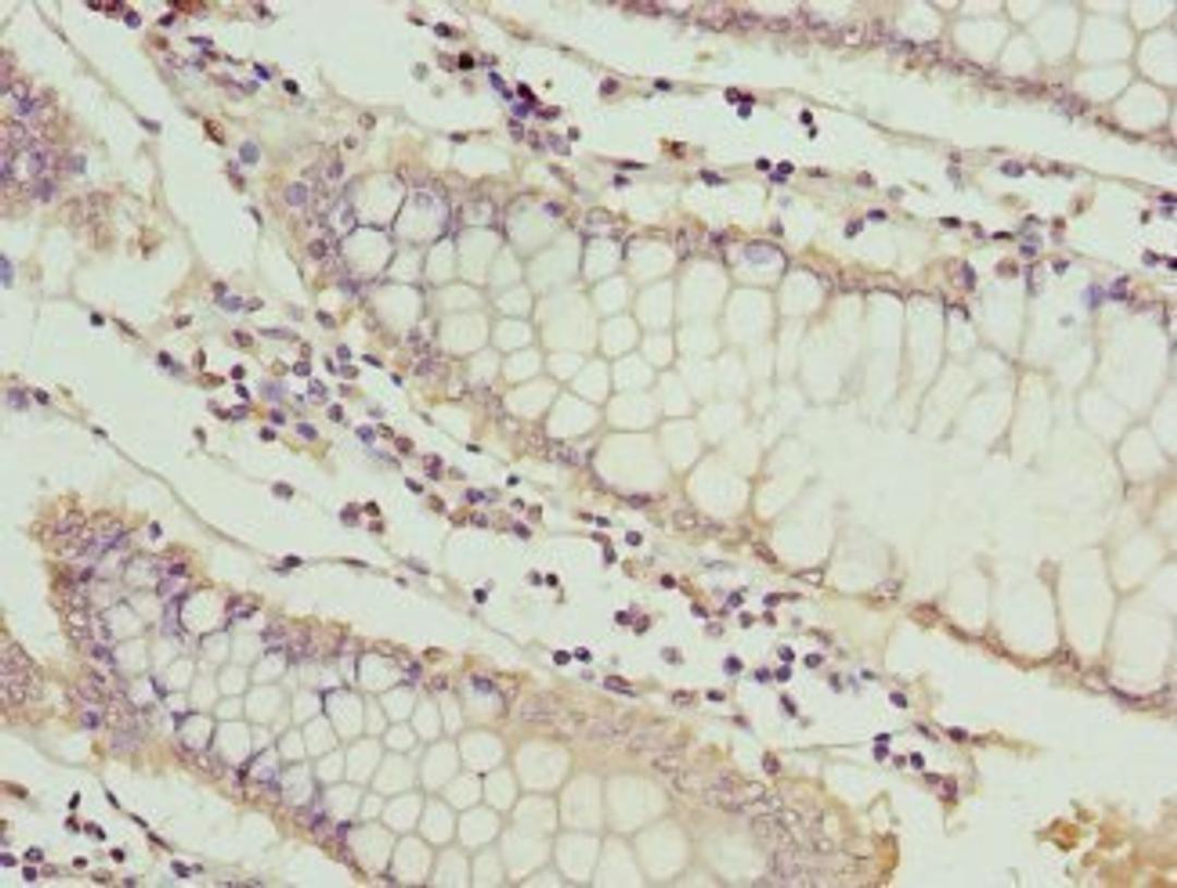 Immunohistochemical staining of human colon cancer using Metallothionein-1G antibody