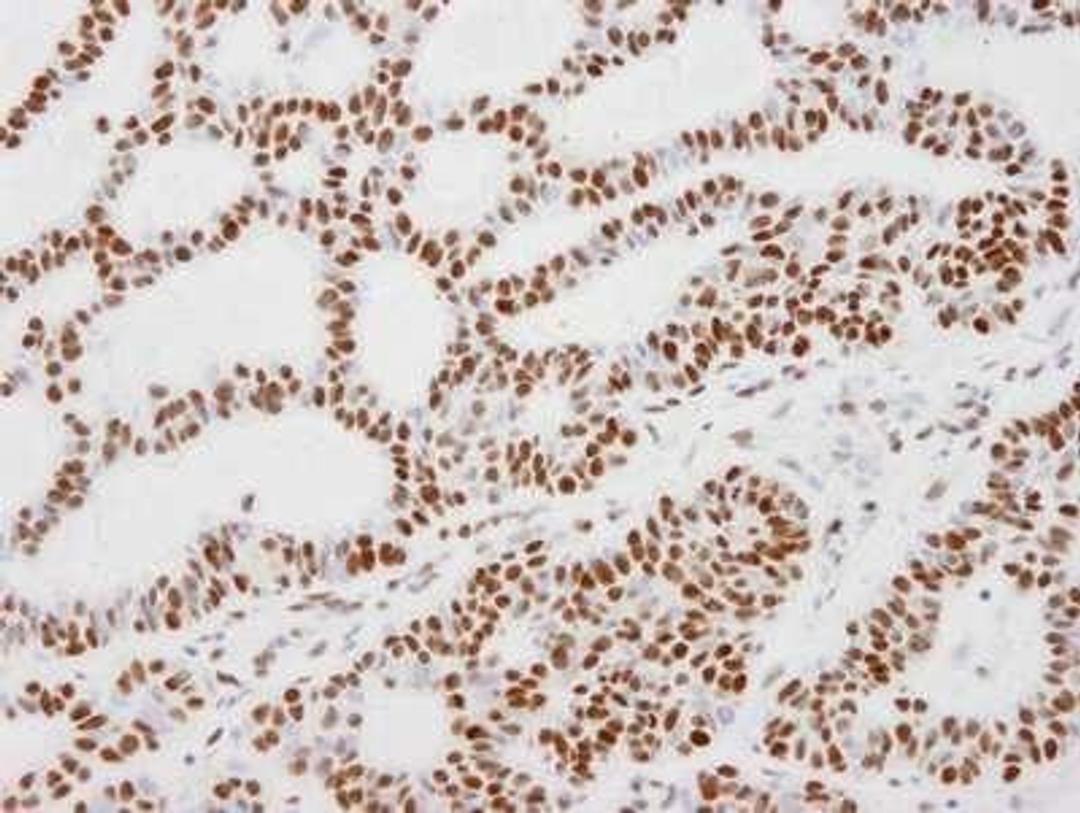 Immunohistochemistry-Paraffin: KAP1 Antibody [NB500-158] - FFPE section of human skin tumor .   Affinity purified rabbit anti-KAP-1 used at a dilution of 1:100.