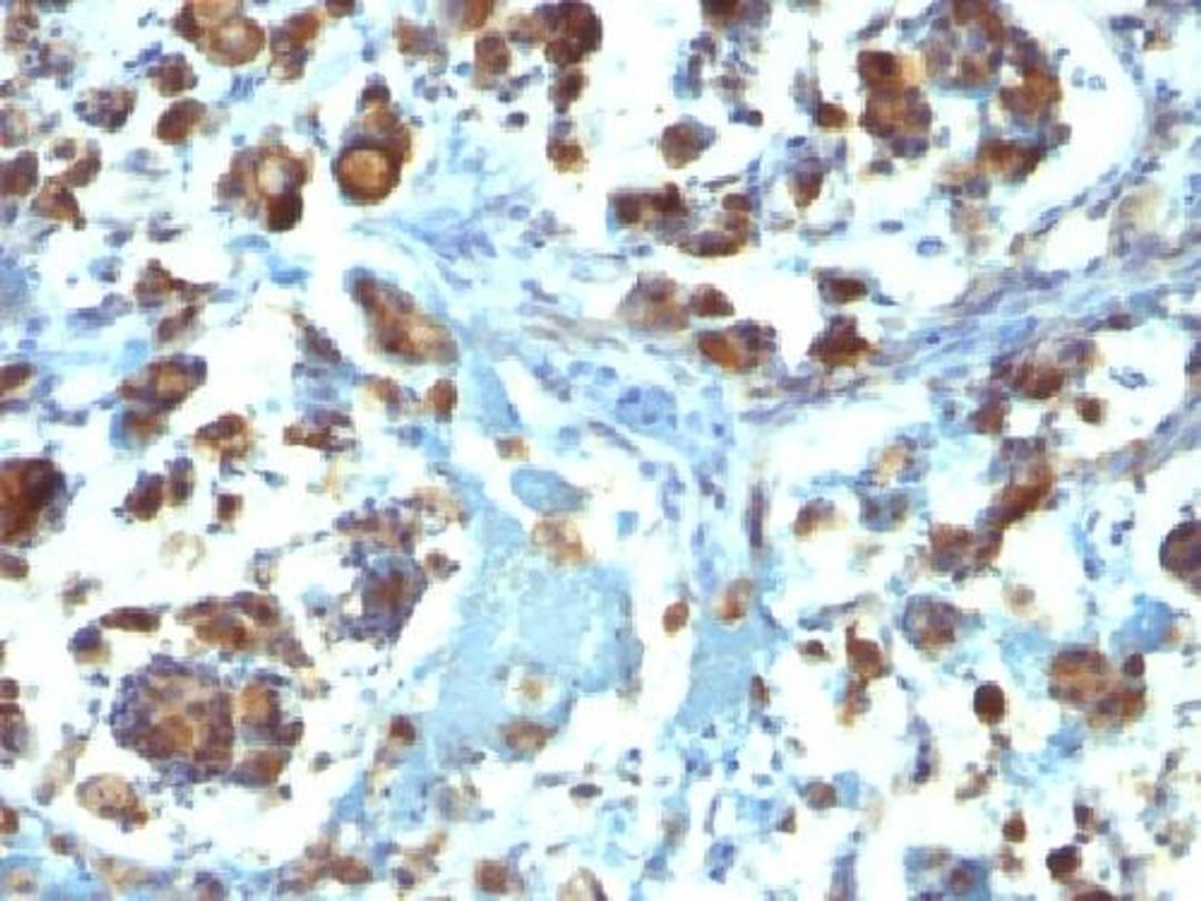 Immunohistochemical staining of human Gastric Carcinoma tissue using MUC3A antibody