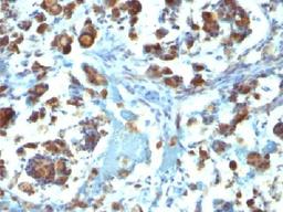 Immunohistochemical staining of human Gastric Carcinoma tissue using MUC3A antibody