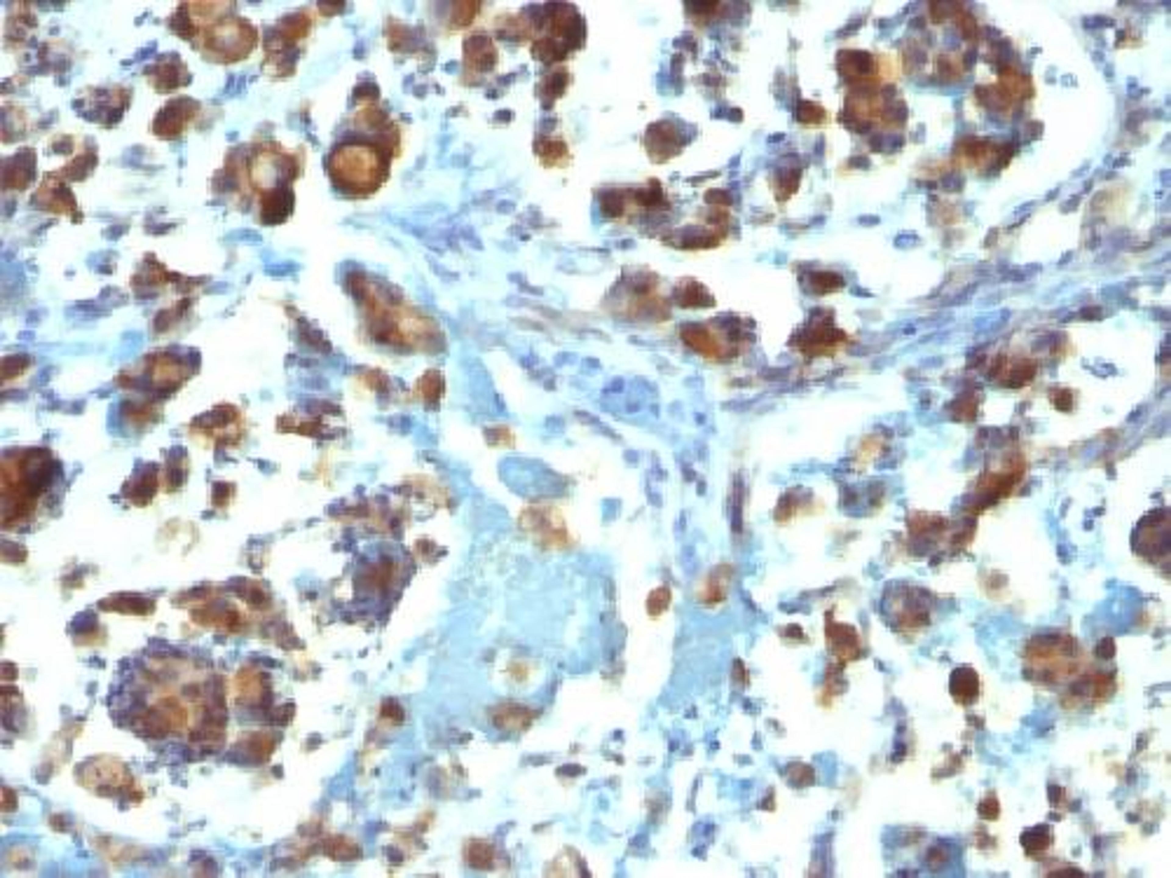 Immunohistochemical staining of human Gastric Carcinoma tissue using MUC3A antibody