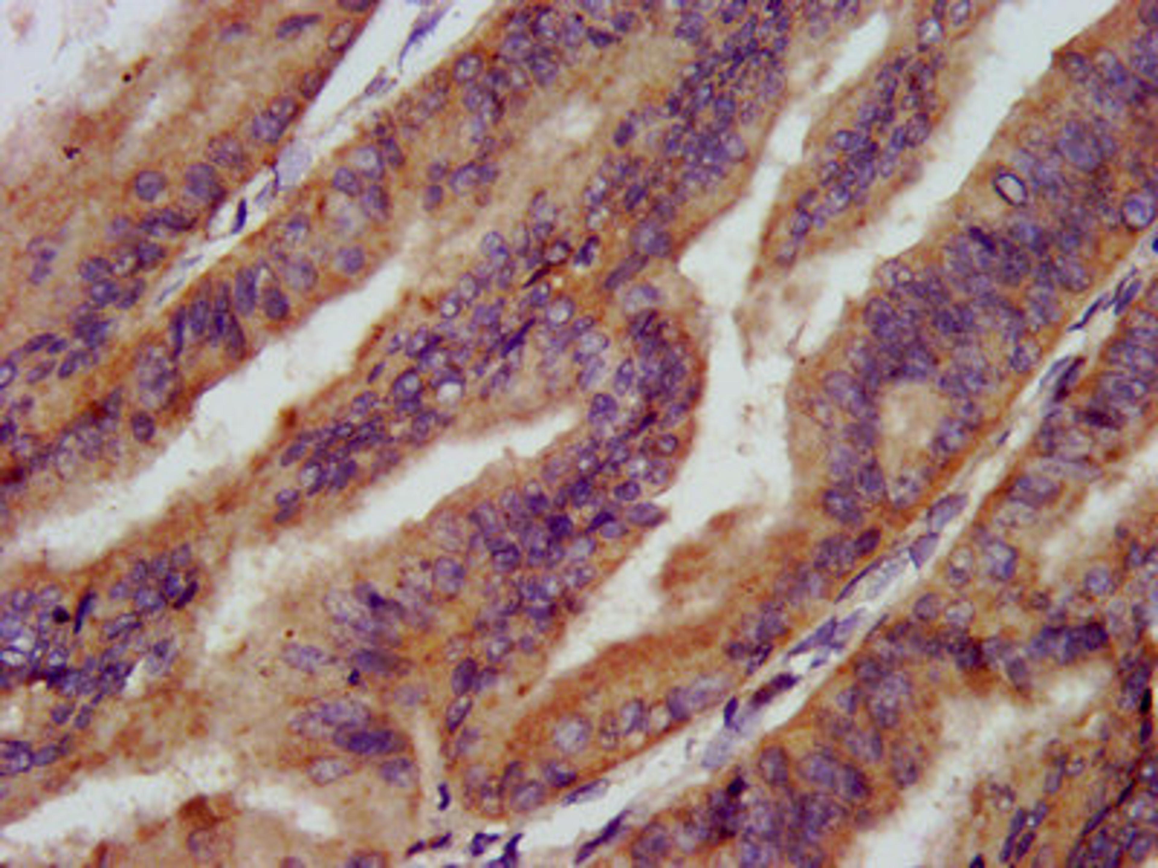 IHC image of CSB-PA021846LA01HU diluted at 1:200 and staining in paraffin-embedded human endometrial cancer performed on a Leica BondTM system. After dewaxing and hydration, antigen retrieval was mediated by high pressure in a citrate buffer (pH 6.0). Section was blocked with 10% normal goat serum 30min at RT. Then primary antibody (1% BSA) was incubated at 4°C overnight. The primary is detected by a biotinylated secondary antibody and visualized using an HRP conjugated SP system.