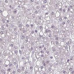 Immunohistochemistry: ZFYVE26 Antibody [NBP2-31606] - liver cancer