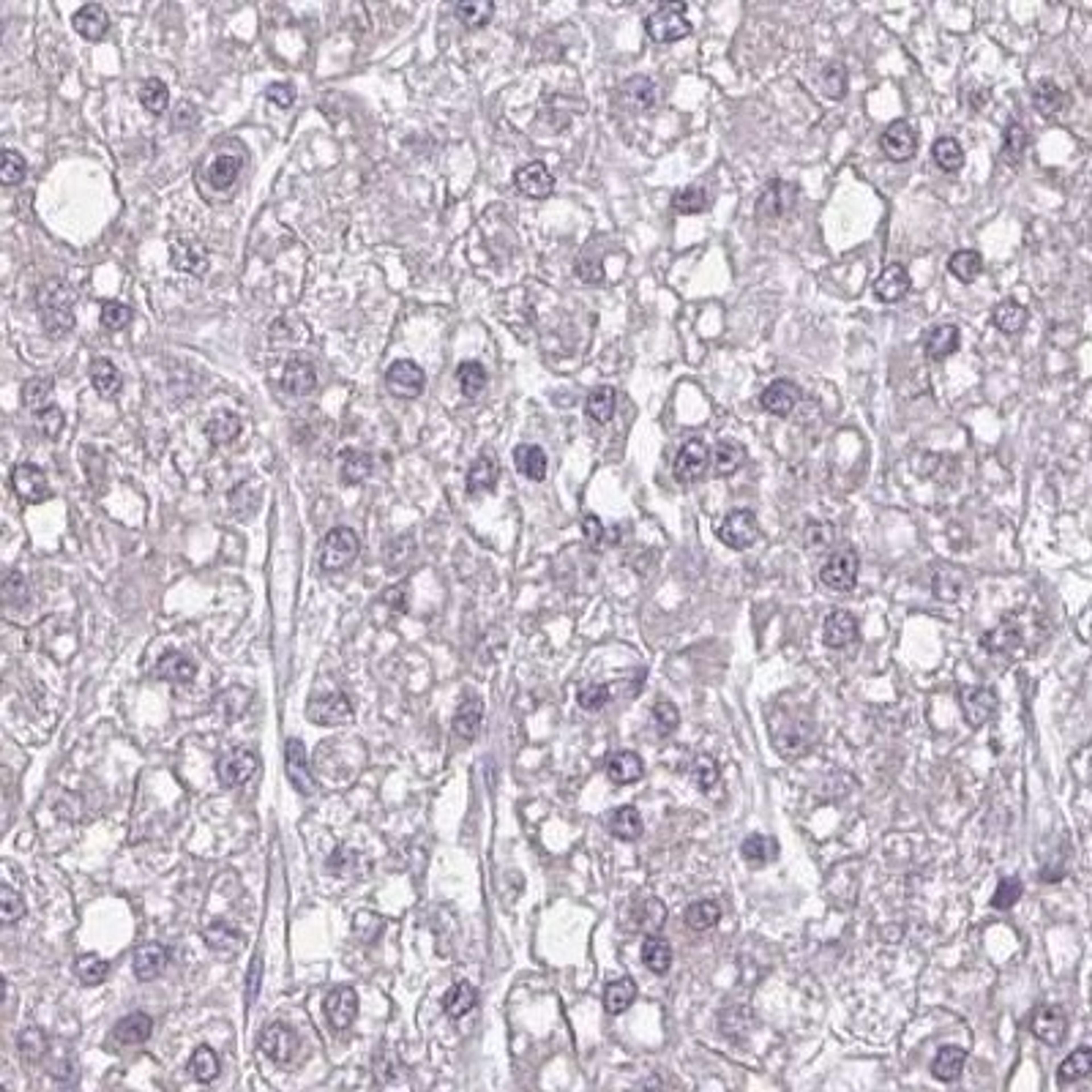 Immunohistochemistry: ZFYVE26 Antibody [NBP2-31606] - liver cancer