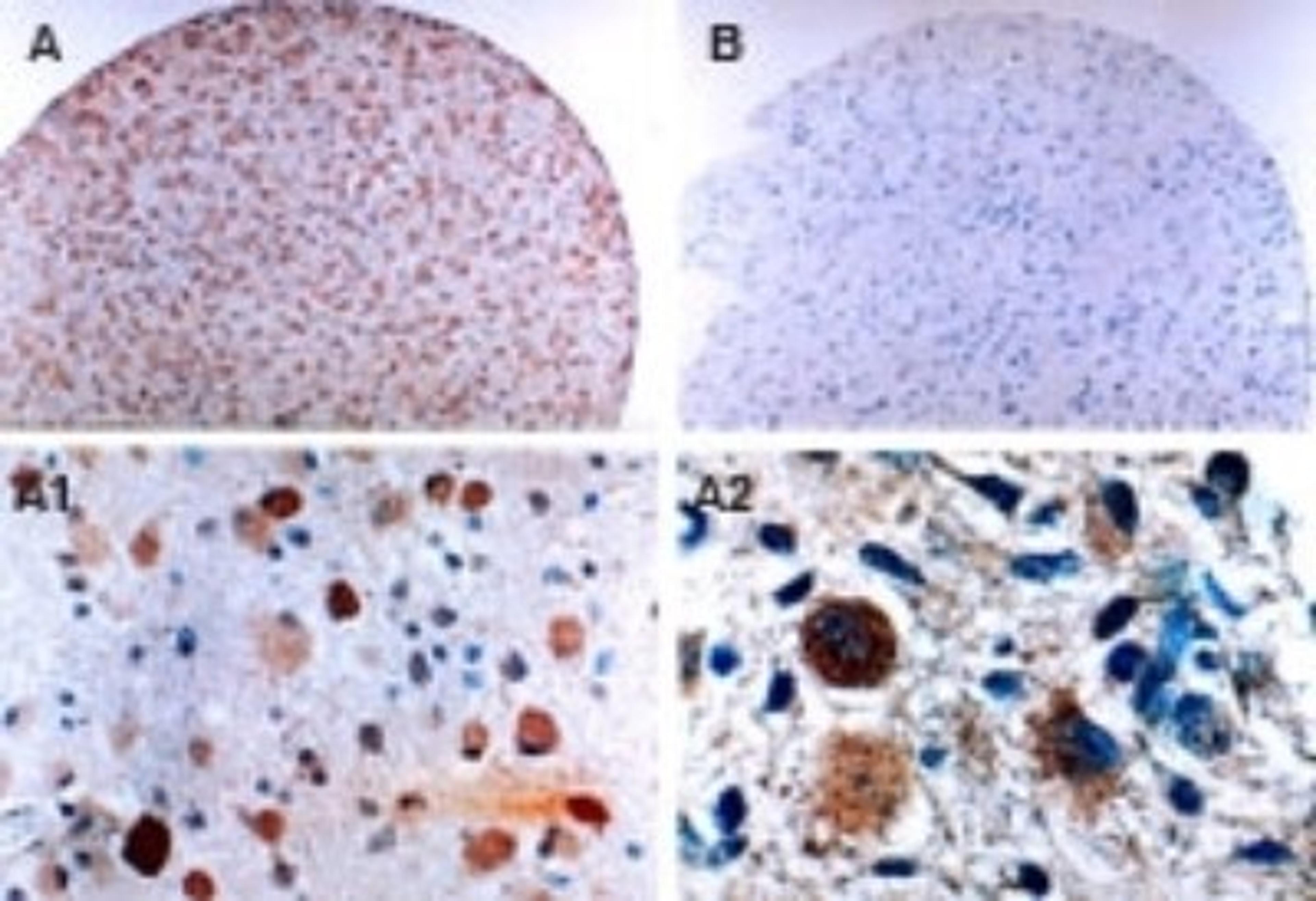 Immunohistochemistry: FLIP Antibody [NB100-56141] - Immunhohistochemical analysis of FLIP in two tissues cores from a formalin-fixed, paraffin-embedded human brain tumor microarray using NB100-56141 at 1:2000. A, gemistocytoma (Grade II) positive for FLIP expression. B, gemistocytoma (Grade II) negative for FLIP expression. A1 and A2 are higher magnifications from A. A, A1, and A2 show expression of FLIP in the gemistocytes of the tumor. Hematoxylin-eosin counterstain.