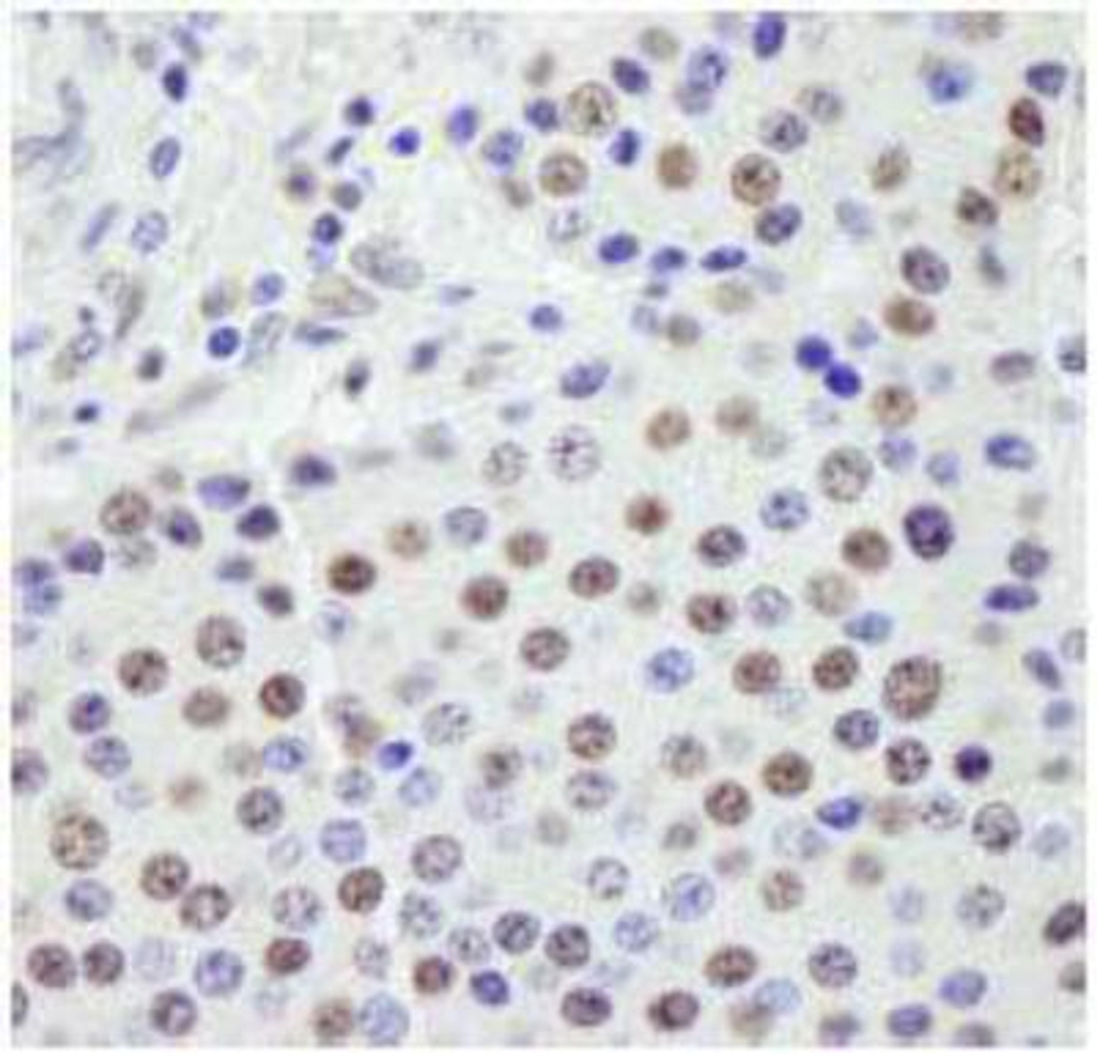 Immunohistochemistry-Paraffin: SF3A1 Antibody [NB100-79843] - Detection of Human SF3a120/SAP114 by Immunohistochemistry. Sample: FFPE section of human pancreatic islet cell tumor. Antibody: Affinity purified rabbit anti-SF3a120/SAP114 used at a dilution of 1:250. Detection: DAB staining using Immunohistochemistry Accessory Kit.