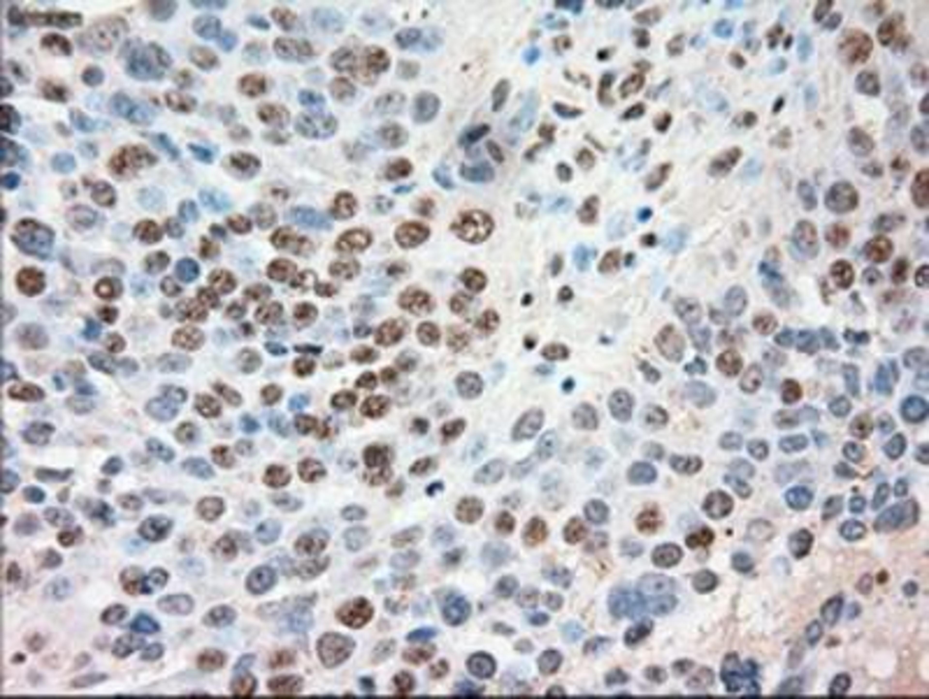 Immunohistochemistry-Paraffin: Siglec-9 Antibody (1D9) [NBP1-47969] - Staining of paraffin-embedded Adenocarcinoma of Human ovary tissue using anti-Siglec-9 mouse monoclonal antibody.