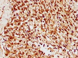 IHC image of CSB-PA010378OA33ncrHU diluted at 1:10 and staining in paraffin-embedded human ovarian cancer performed on a Leica BondTM system. After dewaxing and hydration, antigen retrieval was mediated by high pressure in a citrate buffer (pH 6.0). Section was blocked with 10% normal goat serum 30min at RT. Then primary antibody (1% BSA) was incubated at 4°C overnight. The primary is detected by a biotinylated secondary antibody and visualized using an HRP conjugated SP system.