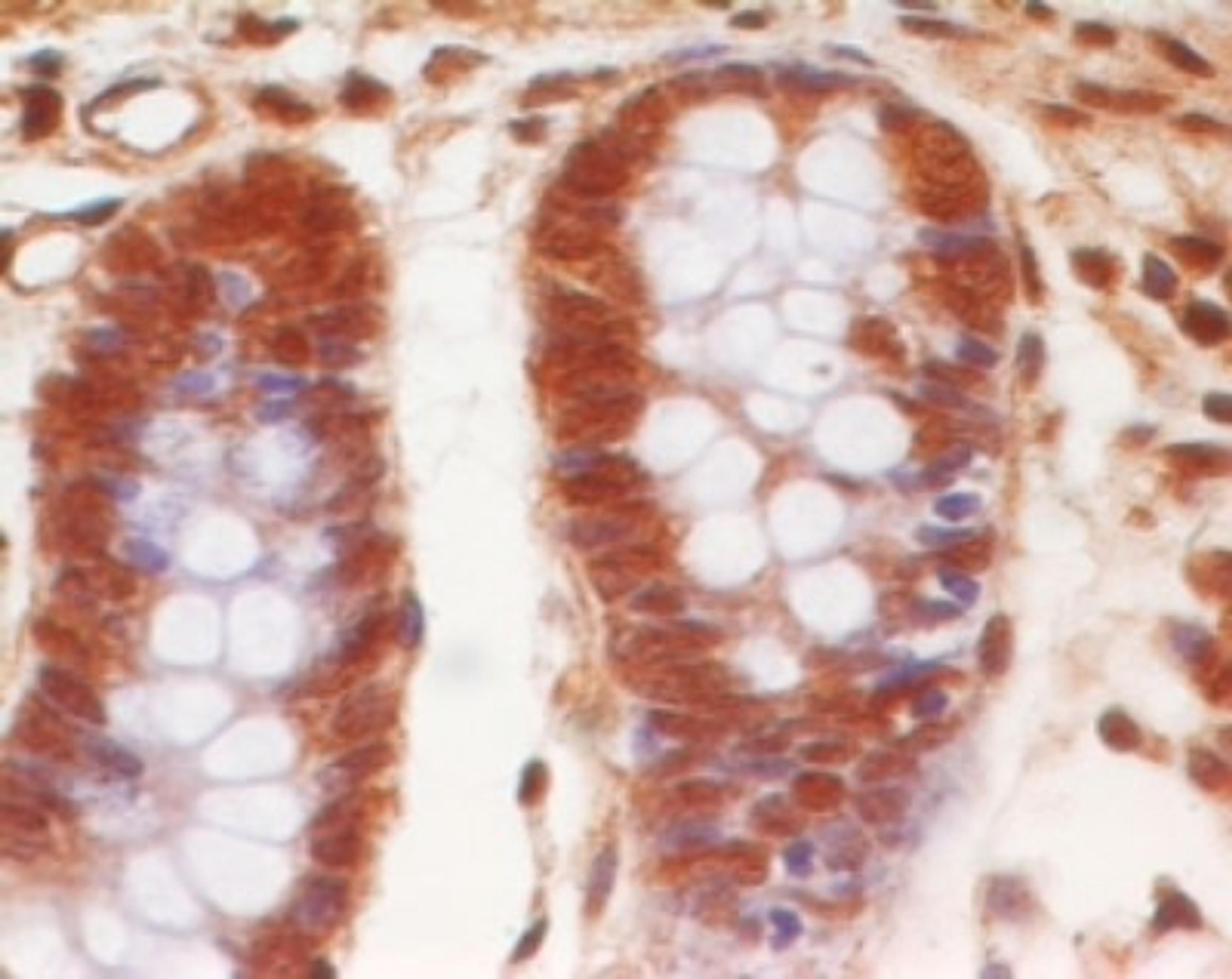 Immunohistochemistry-Paraffin: EPS8 Antibody (18F1F2) [NBP2-27300] - Formalin-fixed, paraffin-embedded human colon cancer stained with EPS8 antibody (5 ug/ml), peroxidase-conjugate and DAB chromogen.