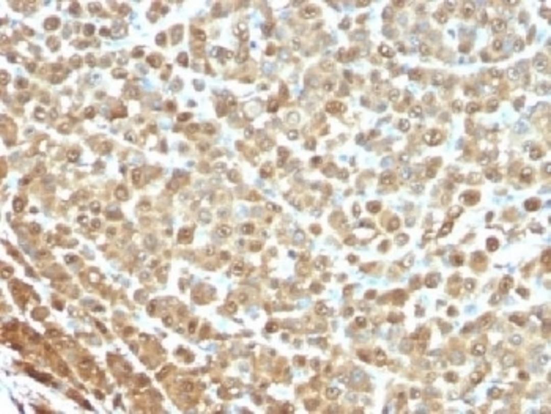 IHC testing of FFPE human melanoma stained with S100A antibody (clone S1-61). Required HIER: boil tissue sections in 10mM citrate buffer, pH 6, for 10-20 min followed by cooling at RT for 20 min.