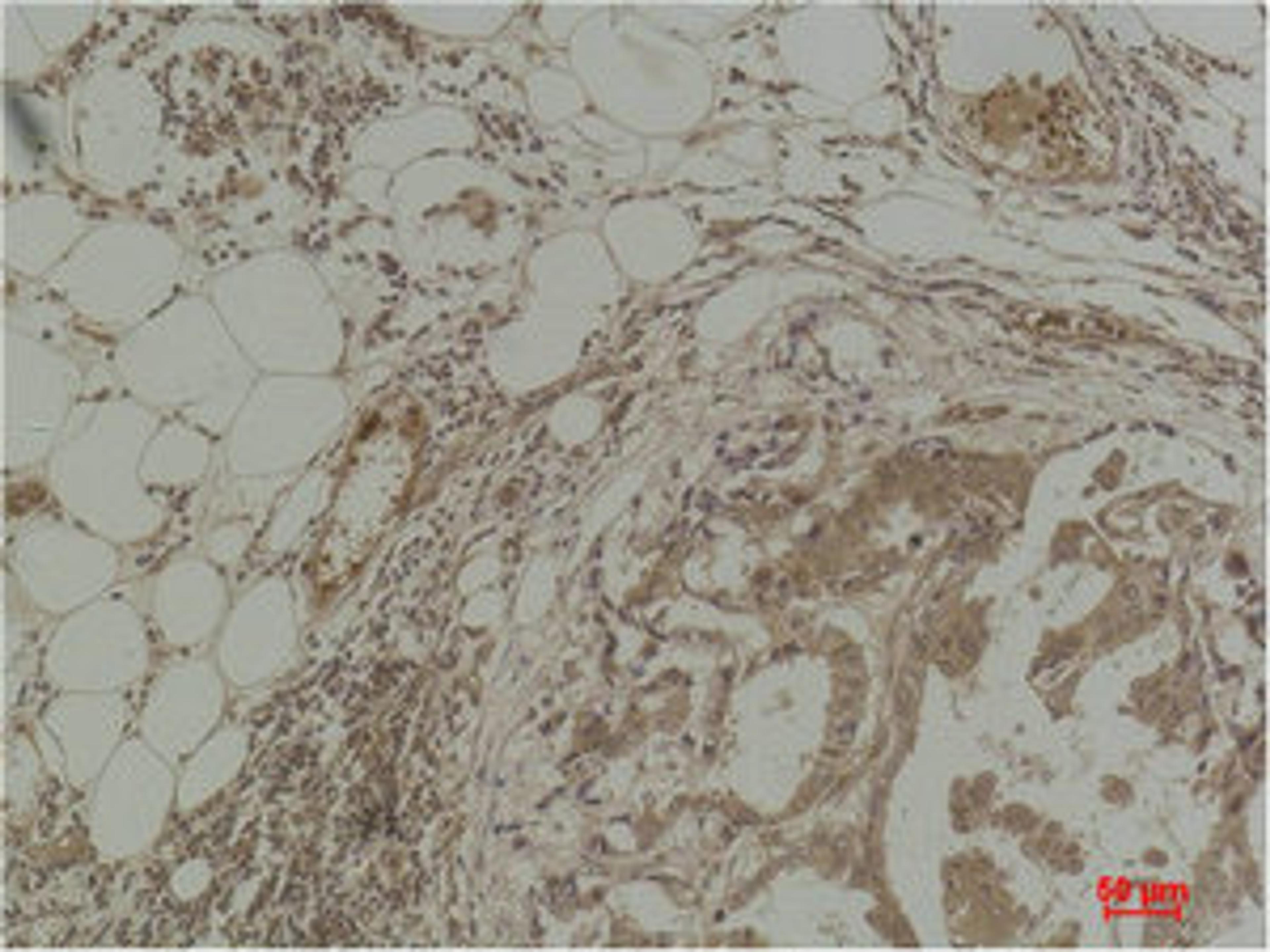 Immunohistochemical analysis of paraffin-embedded Human Breast Carcinoma using Pan Methylated Lysine Monoclonal Antibody.
