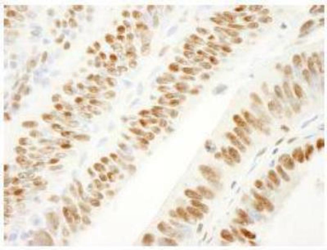 Immunohistochemistry-Paraffin: SAM68 Antibody [NBP1-19151] - Detection of Human SAM68 by Immunohistochemistry. Sample: FFPE section of human colon carcinoma. Antibody: Affinity purified rabbit anti-SAM68 used at a dilution of 1:250. Detection: DAB staining using Immunohistochemistry Accessory Kit.